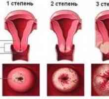Stadiul de cancer de col uterin, tratamentul si prognosticul bolii pentru fiecare etapă