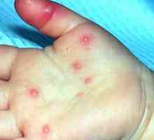 Infectie cu enterovirus la copii. Simptomele, tratamentul și prevenirea