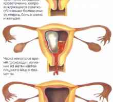 Amenințarea întreruperii sarcinii (avort) în fazele incipiente