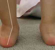 Valgus picior deformare la un copil: de ce există o încălcare?