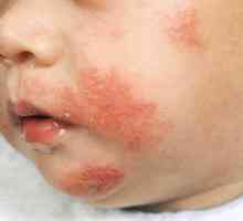 Tipuri de boli dermatologice la copii