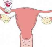 Sarcina ectopică la începutul sarcinii: semne și simptome