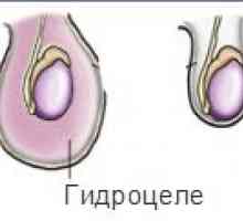 Hidropizie testicular și funcționarea la rebenka.lechenie