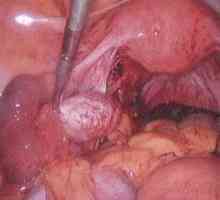 Inflamația a uterului si ovarelor (ooforita, salpingită, anexita)