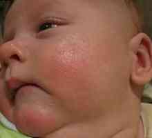 Staphylococcus aureus la nou-nascuti