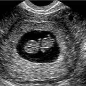 6 Săptămâni de gestație: simt la începutul sarcinii