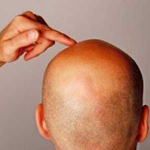 Alopecia la nou-născuți: tipuri și cauze