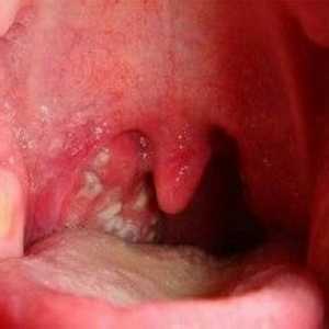 Durere în gât la copii - Tipuri, simptome și tratament