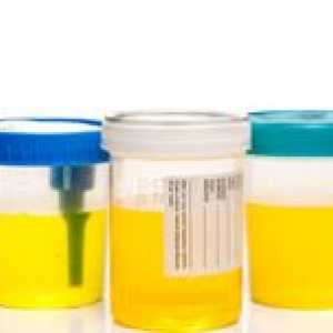 Analiza biochimică a urinei