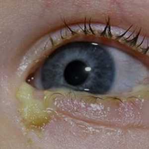 Ce se poate face în cazul în care un copil supurează ochii