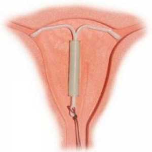 Ce trebuie să știți despre menstruație după spirala?