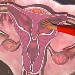Ce este uterul cu două coarne? Sarcina și anomalie.