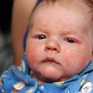 Ce este eritem și de ce se dezvoltă la nou-nascuti?