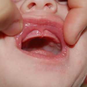 Cauzele drojdie infecție la sugari în gură și cum să se ocupe cu boala