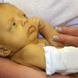Boala hemolitica a nou-născutului