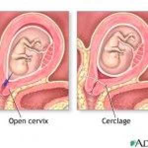 Incompetenta cervicala. Siptomy și tratamentul CIN în timpul sarcinii