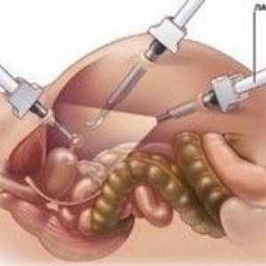 Cum este chist ovarian laparoscopic?