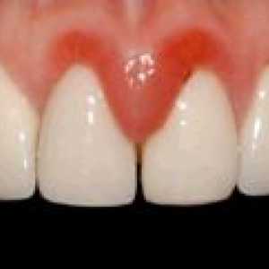 Cum de a elimina inflamarea gingiilor din jurul dintelui
