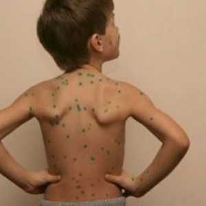 Care sunt complicatiile sau consecintele dupa varicela la copii