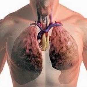 Care sunt simptomele de cancer pulmonar?