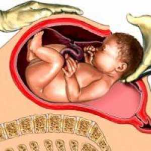 Cesarean nașterii sau vaginală, contra naștere