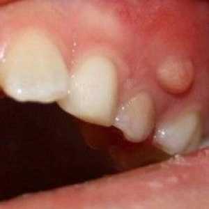 Periuțe de dinți: cauze, simptome, tratament