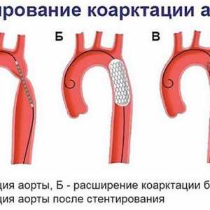 Coarcta a aortei la copii - cauze, tipuri, tratament