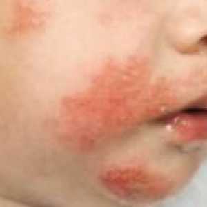 Dermatită de contact la copii