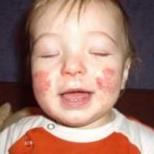 Boli de piele la copii