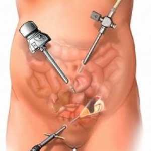 Laparoscopie Chist ovarian: caracteristici și complicații