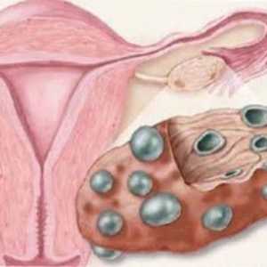 Ovare Multifollikulyarnye si sarcina
