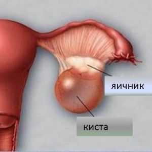 Cât de periculos chist ovarian in timpul sarcinii? Metodele pentru tratarea bolii.