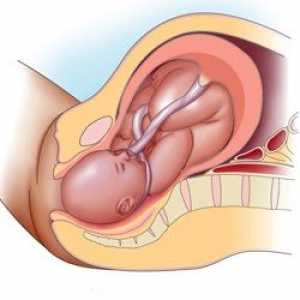 Entanglement din cordonul ombilical la 32 de săptămâni de gestație