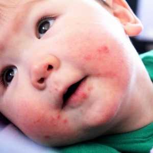 Pericol virusul Coxsackie pentru copii