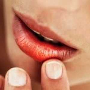 Cauzele și tratamentul fisuri la colturile gurii
