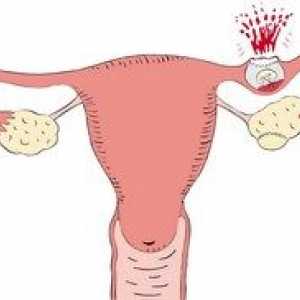 Cauze și simptome ale unei sarcini extrauterine