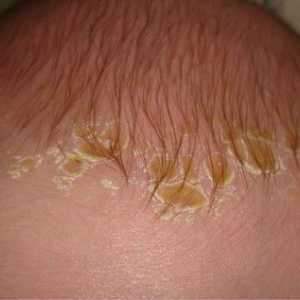Cauzele descuamarea pielii la nou-nascuti