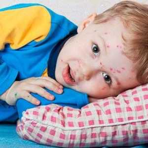 Semne de scarlatină la copii, tratamentul și prevenirea
