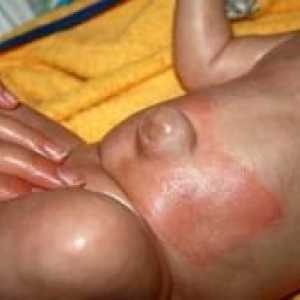 Hernie ombilicala la nou-născuți