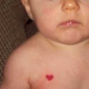 Birthmarks la nou-nascuti
