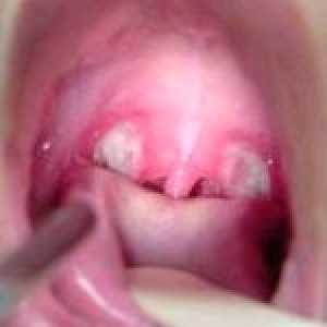 Simptomele de faringitei acute și cronice