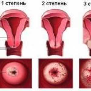 Stadiul de cancer de col uterin, tratamentul si prognosticul bolii pentru fiecare etapă