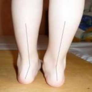 Valgus picior deformare la copii