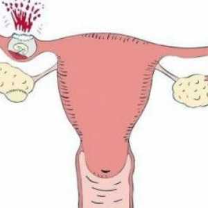 Sarcina ectopică la începutul sarcinii: semne și simptome